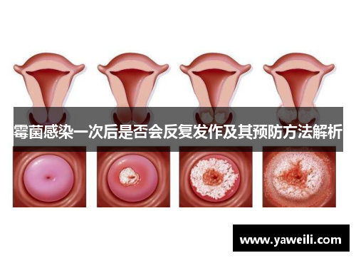 霉菌感染一次后是否会反复发作及其预防方法解析